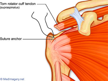 rotator cuff surgery shoulder older getting sling